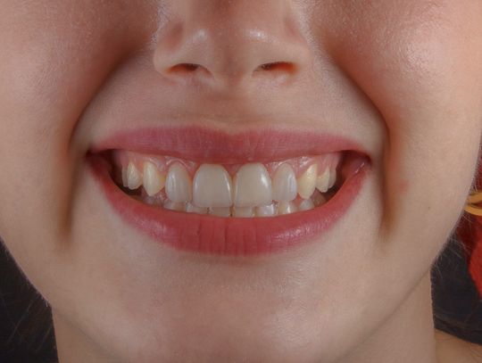 Osad czy już kamień? Dowiedz się, jak powstrzymać cichego wroga Twojego uśmiechu