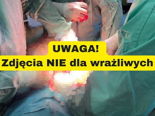 W kaliskim szpitalu wycięli mega guza! Miała go młoda kobieta