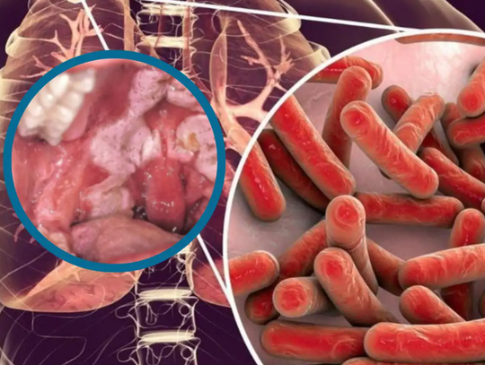 Wykryli u niego groźną bakterię. Mężczyzna nie żyje