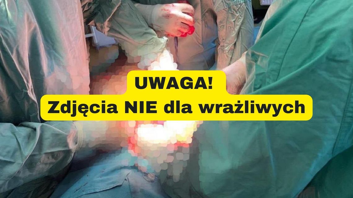 W kaliskim szpitalu wycięli mega guza! Miała go młoda kobieta