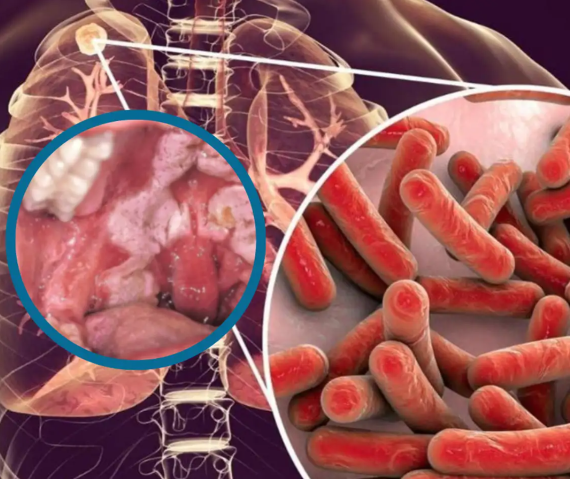 Wykryli u niego groźną bakterię. Mężczyzna nie żyje Wykryli u niego groźną bakterię. Mężczyzna nie żyje